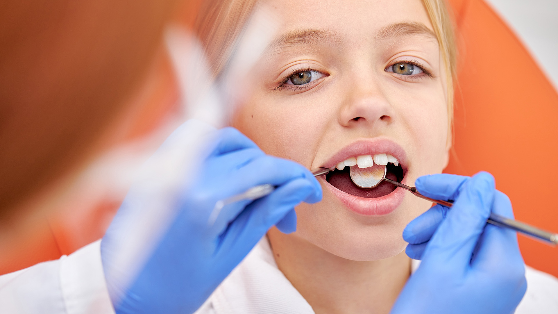 Dental Sealants for Kids - Protecting Young Smiles